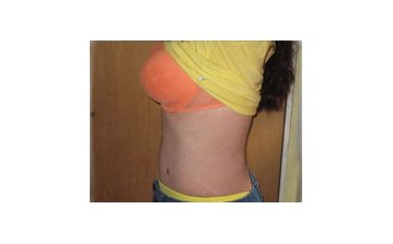  Tummy tuck - After treatment