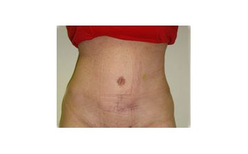  Tummy tuck - After treatment