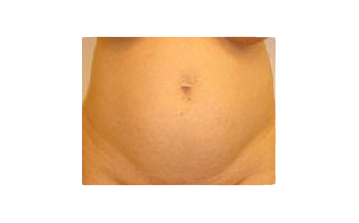  Tummy tuck - Before treatment