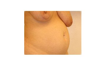 Tummy tuck - Before treatment